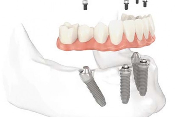 Full Set Dental Implants
