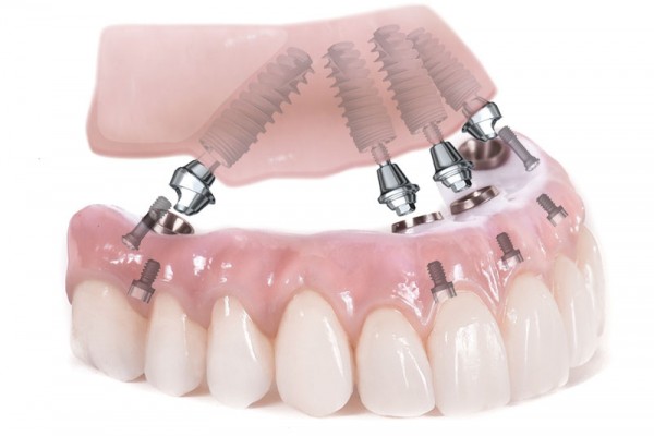 Teeth Implants Overview