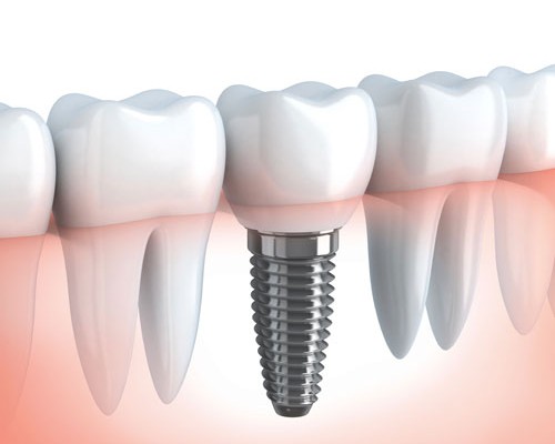Single Teeth Implants